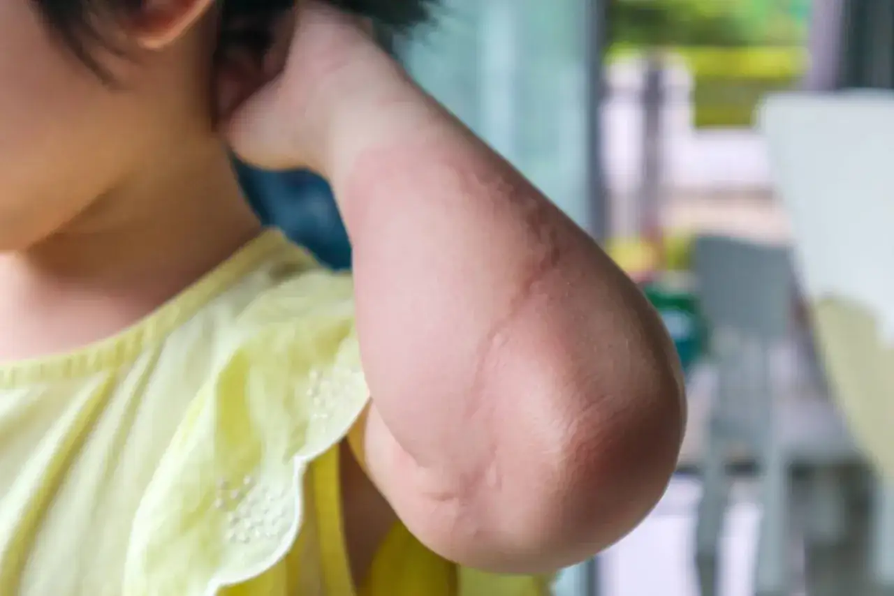 Dziecko ma zaczerwienioną rękę z widocznymi śladami po ukąszeniach, co sugeruje uczulenie na komary.