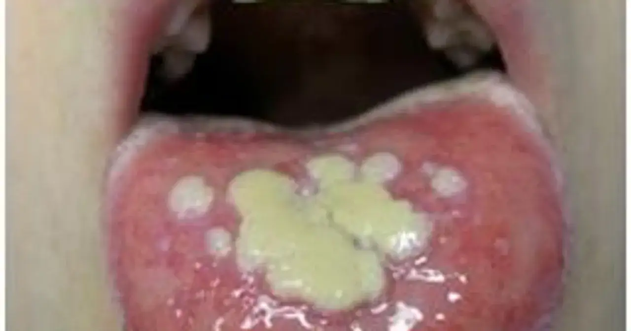 Język z licznymi, bolesnymi aftami. Zastanawiasz się, od czego powstają afty? Mogą być objawem stresu, niedoborów lub infekcji.