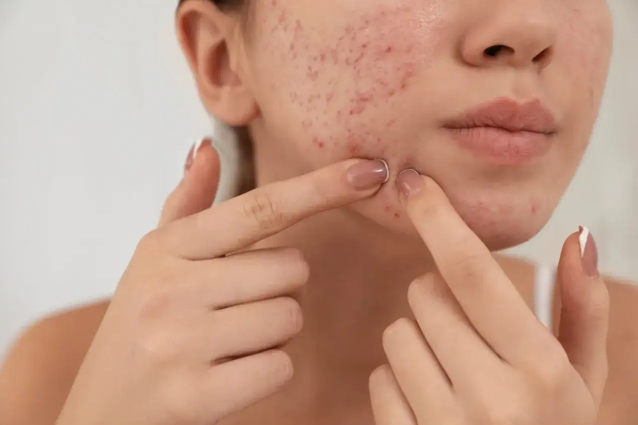 wyciskanie pryszczy konsekwencje blizny