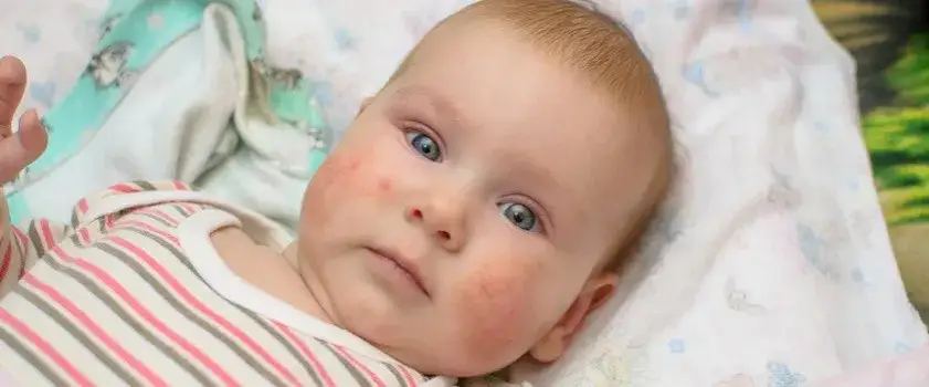 Zdjęcie Rumień zakaźny: kiedy dziecko może wrócić do przedszkola?