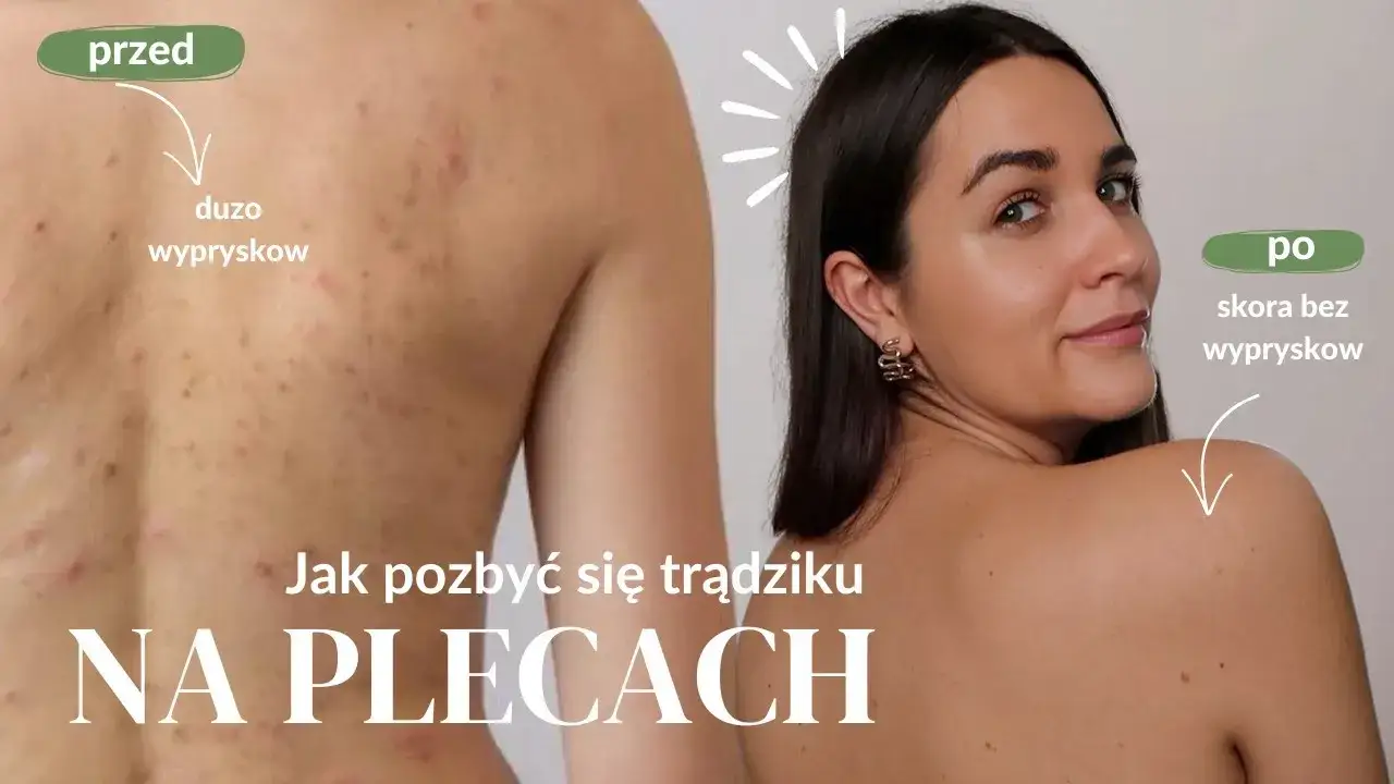 Zdjęcie Skuteczne sposoby na pryszcze na plecach - uniknij bólu i blizn