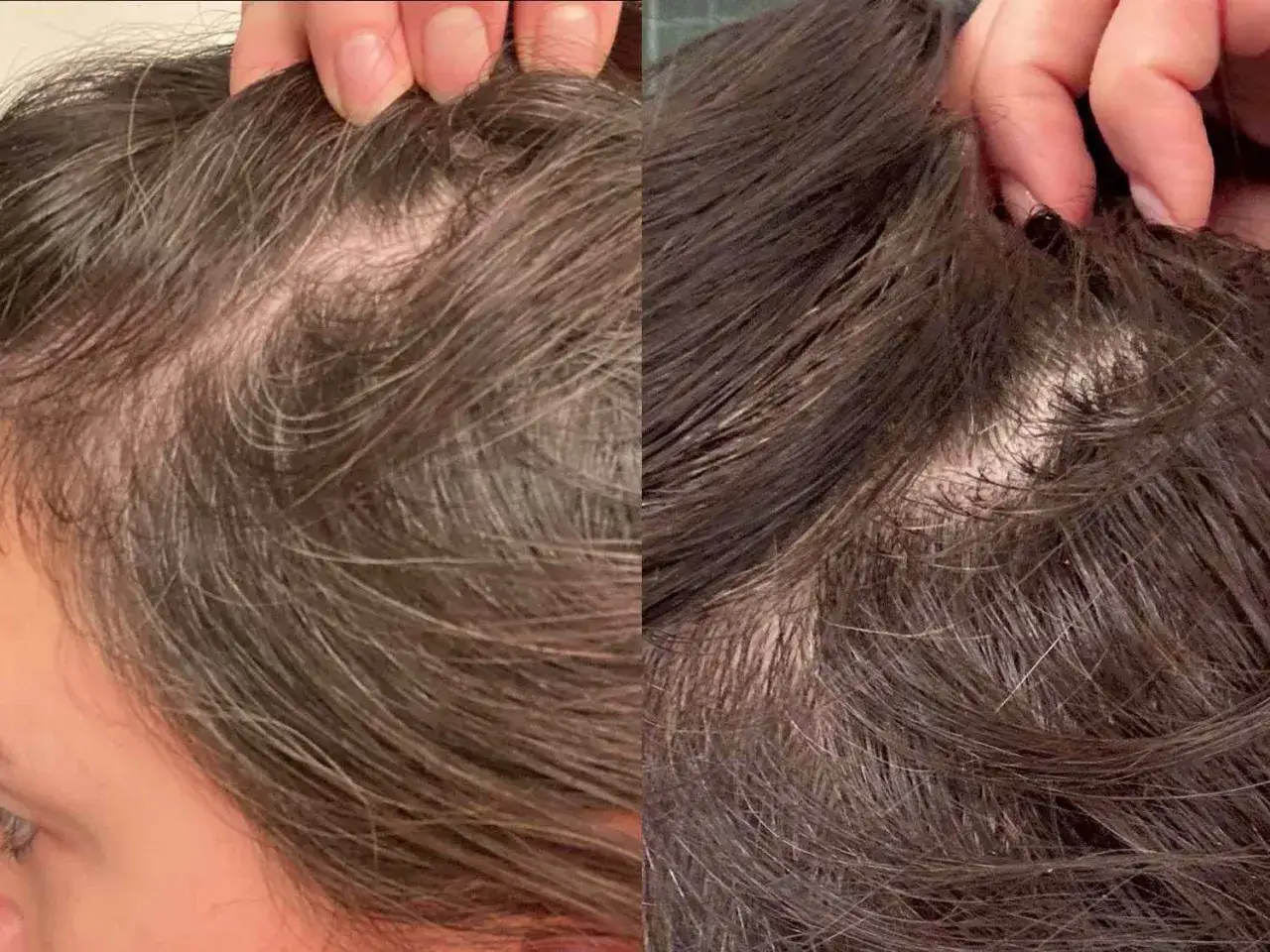 Porównanie skóry głowy: po lewej widoczne przerzedzenie włosów, po prawej gęstsze włosy. Zmagam się z nadmiernym wypadaniem włosów.