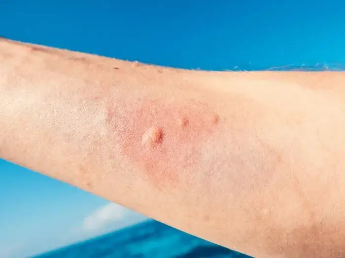 Pierwsza pomoc po poparzeniu meduzy