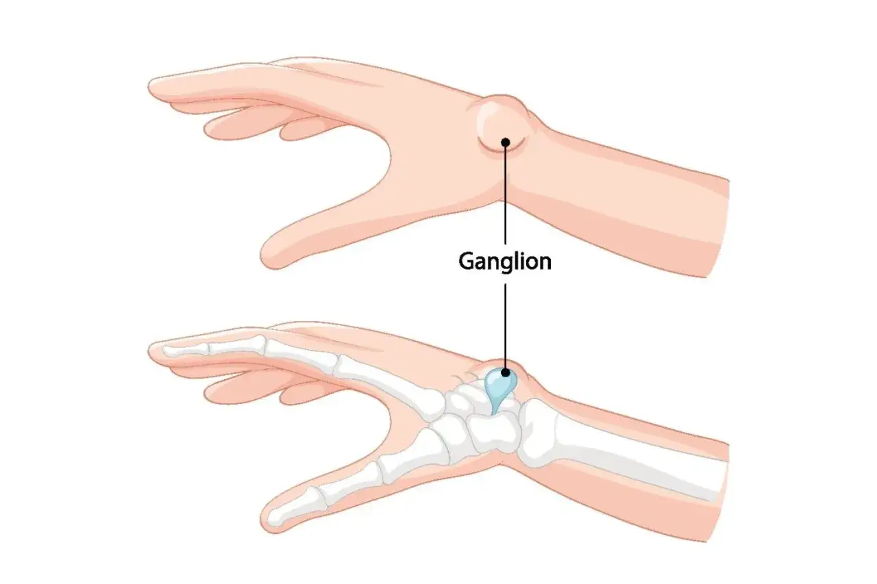 Widok dłoni z widocznym twardym guzem na wewnętrznej stronie, oznaczonym jako ganglion. Poniżej przekrój ukazujący jego położenie przy kościach nadgarstka.