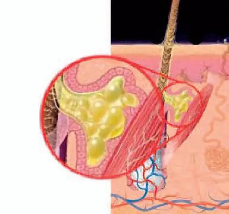 strefa T twarzy anatomia gruczoły łojowe