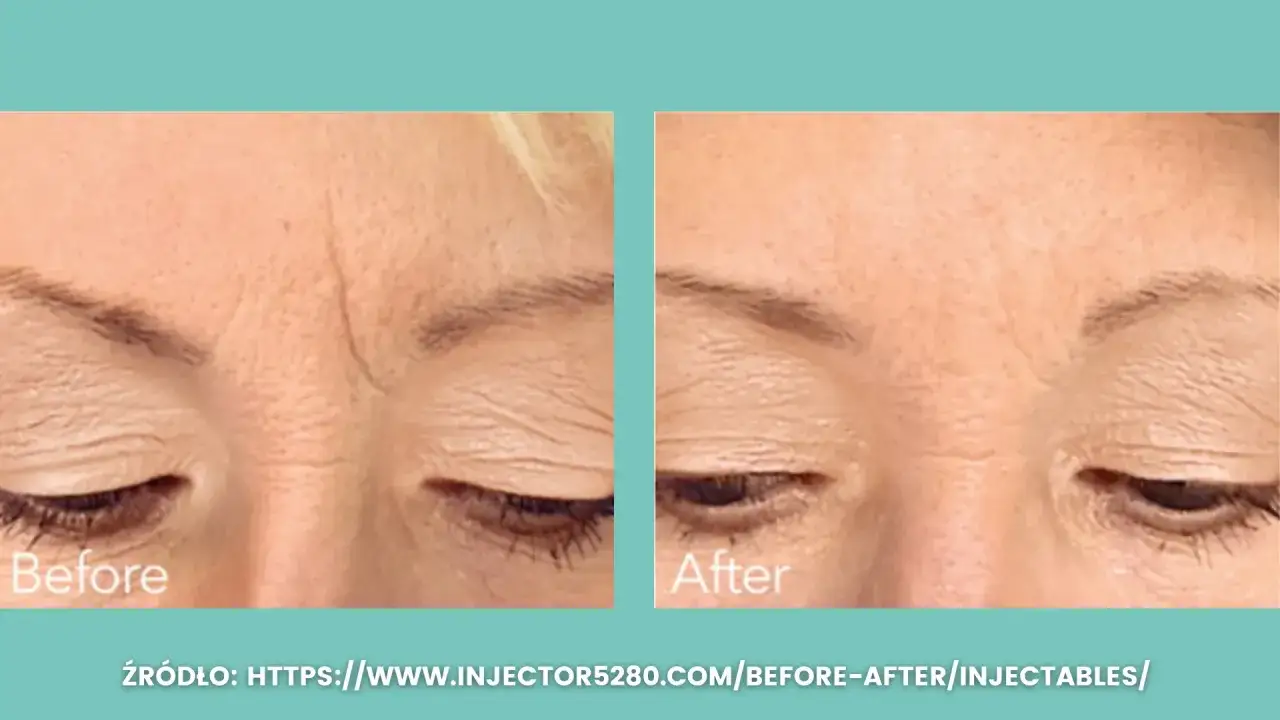 Kwas hialuronowy lwia zmarszczka przed po