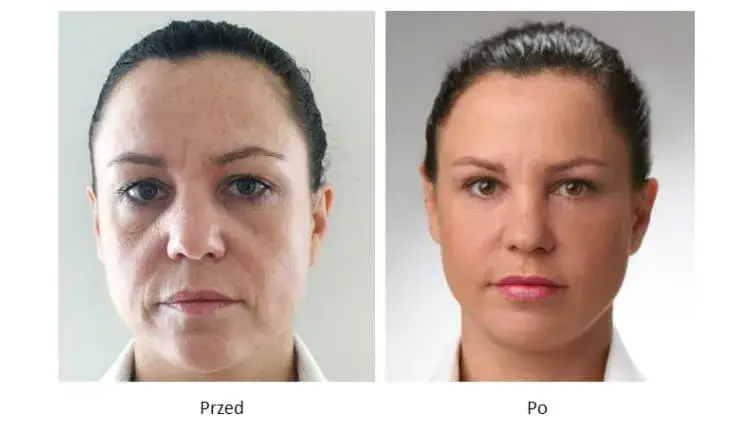 Zabiegi kosmetologiczne na twarz przed i po