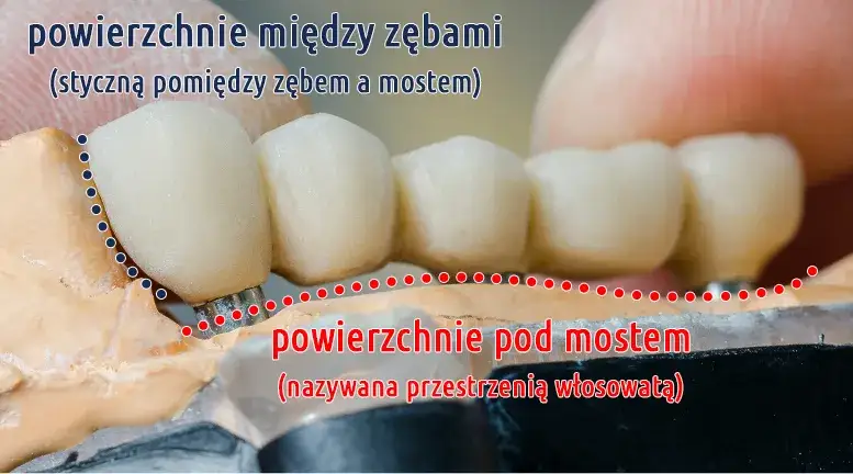 czyszczenie mostu protetycznego
