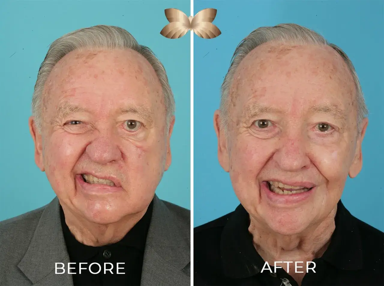 Przed i po: złagodzenie opuchlizny i asymetrii twarzy spowodowanej zapaleniem nerwu tr&oacute;jdzielnego.