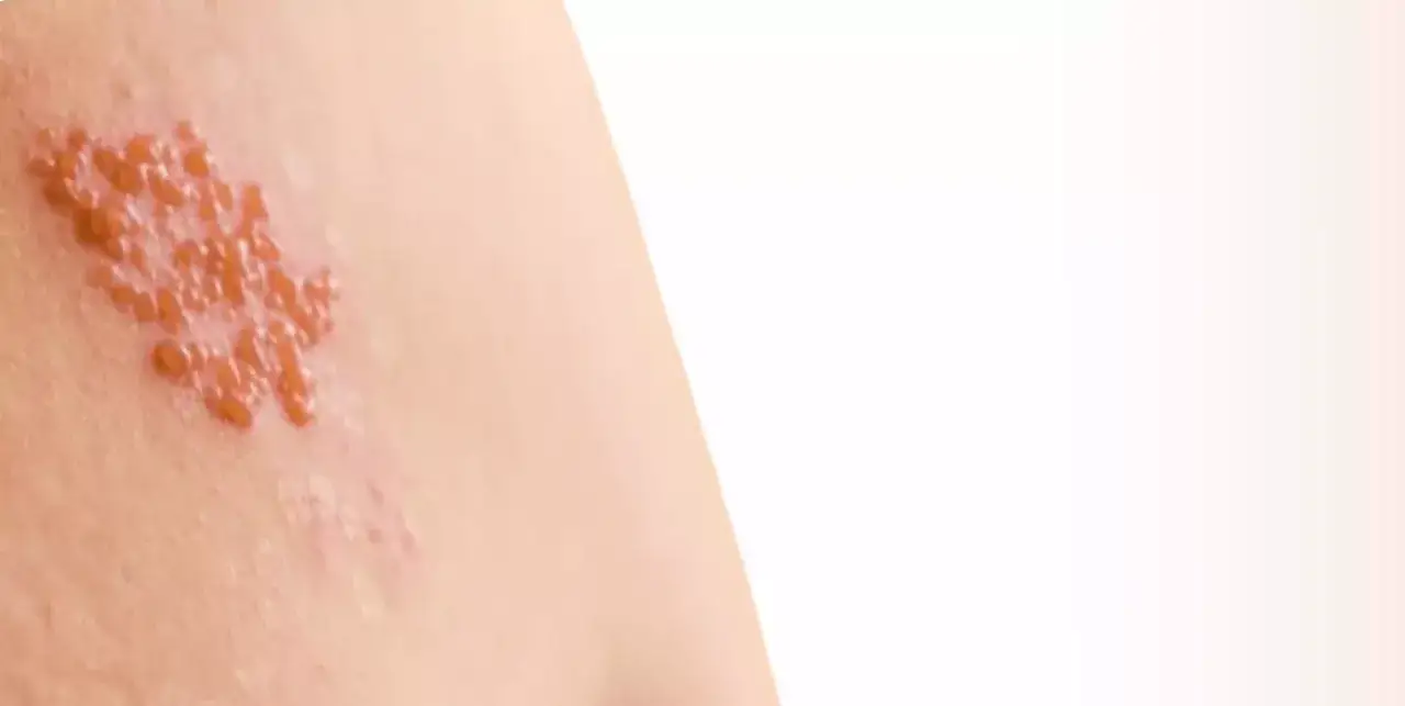 leki przeciwwirusowe półpasiec