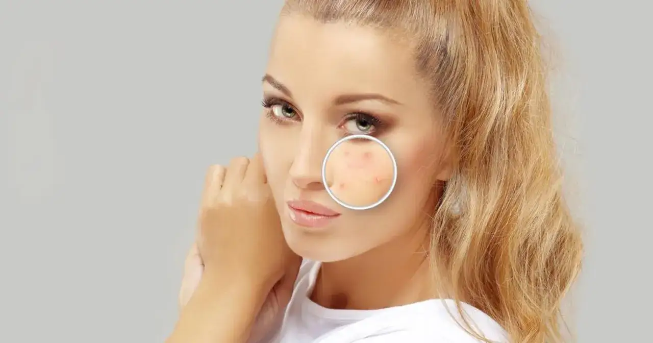 Apteczne preparaty na pryszcze, składniki aktywne trądzik