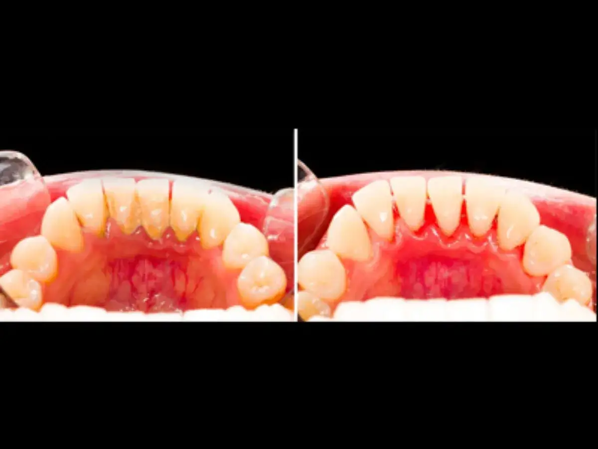 Przed i po wybielaniu zęb&oacute;w. Po lewej widać osad, kt&oacute;ry pokazuje, od czego robi się kamień na zębach. Po prawej zęby są czyste i białe.