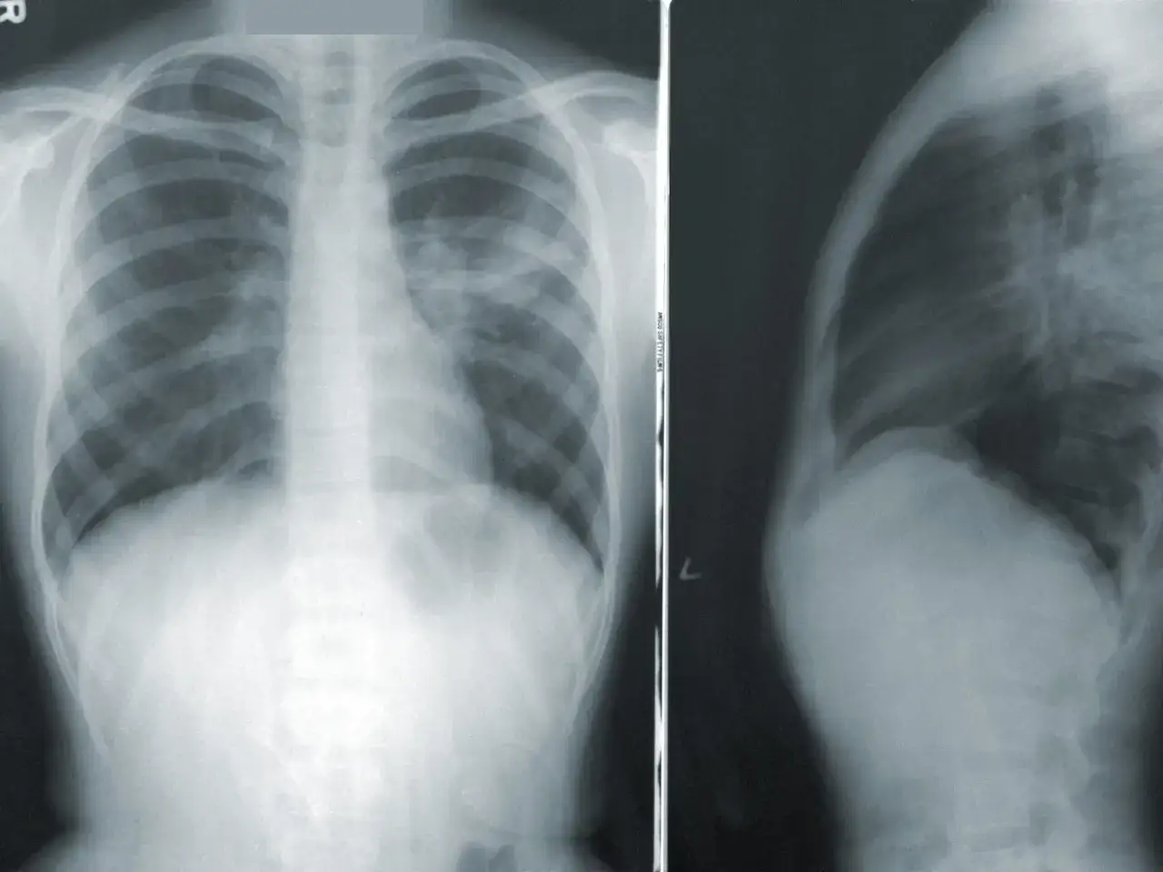 RTG klatki piersiowej pokazuje zmiany sugerujące zapalenie płuc. Czy zapalenie płuc jest zaraźliwe? Tak, wiele typ&oacute;w zapalenia płuc jest zaraźliwych.