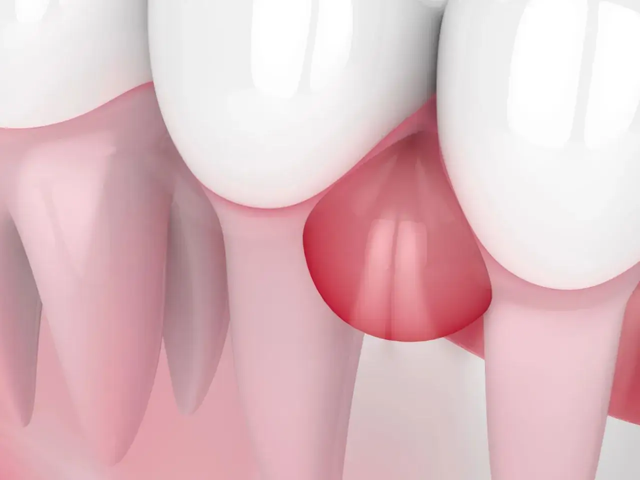 Widok zbliżenia na zęby i dziąsła, gdzie widoczne jest zaczerwienienie i obrzęk, wskazujące na ropne zapalenie dziąseł.