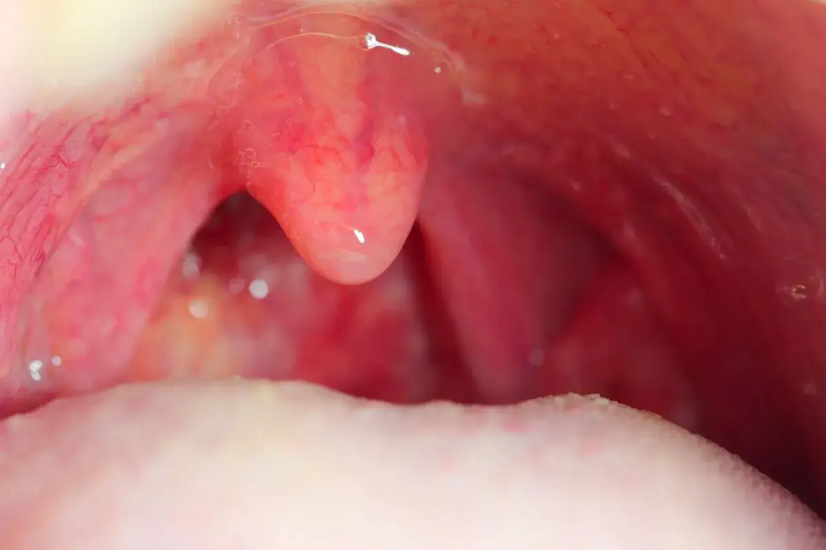 Widok gardła z widocznym, zaczerwienionym nalotem na migdałku, sugerującym obecność paciorkowca.