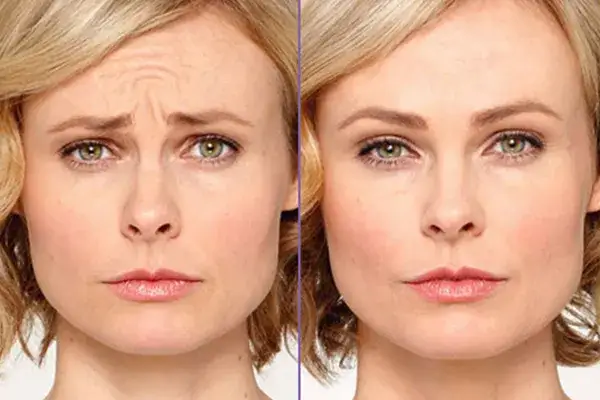 Botoks przed i po zmarszczki mimiczne