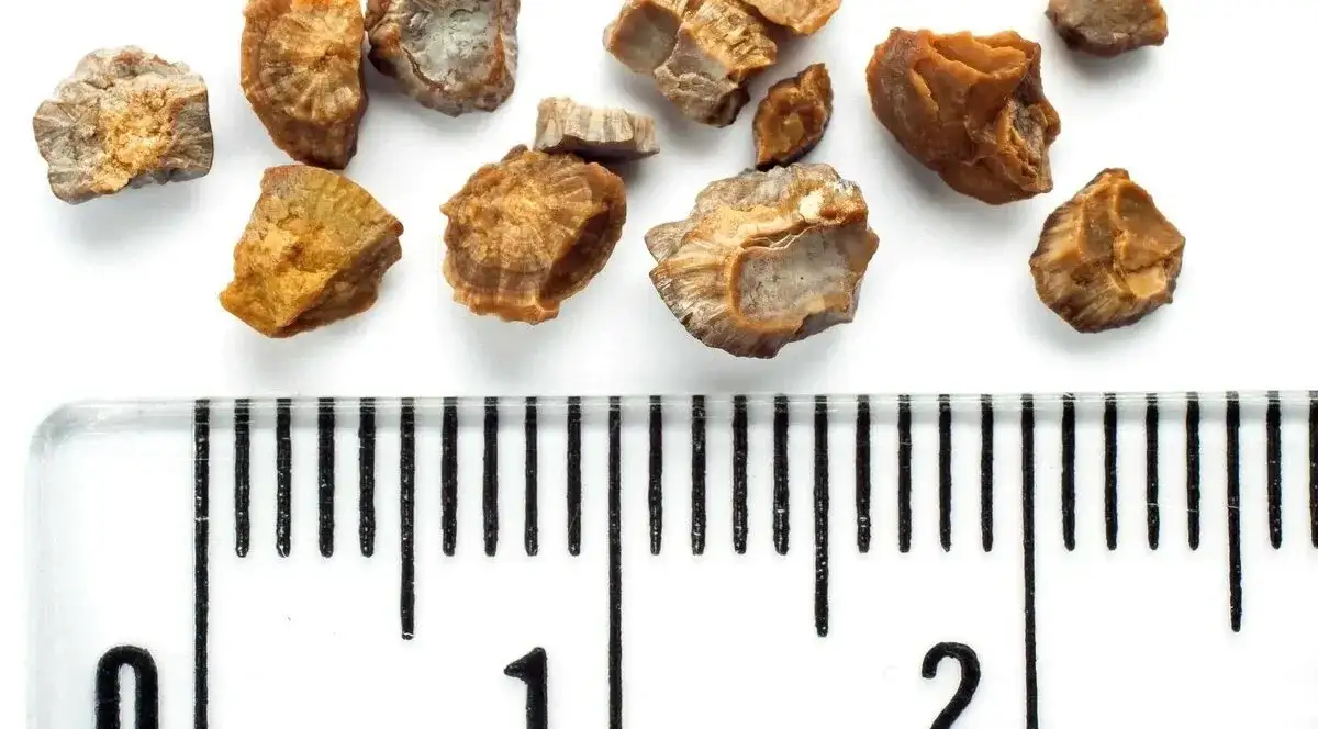 kamienie nerkowe rodzaje