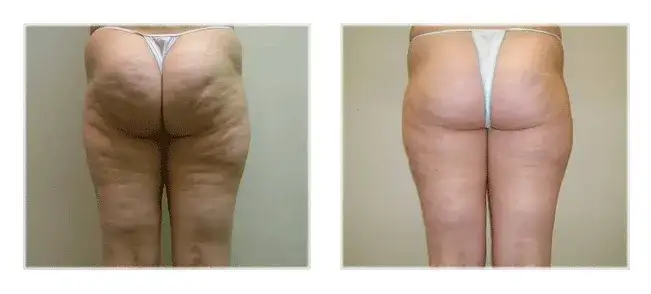 por&oacute;wnanie zabieg&oacute;w antycellulitowych