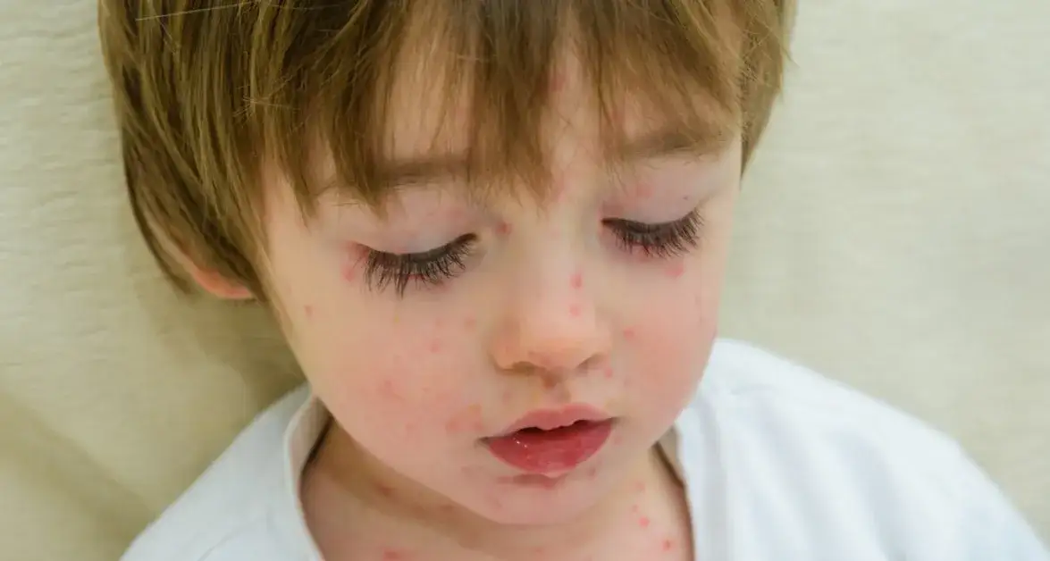 Zdjęcie Szkarlatyna kiedy do przedszkola? Sprawdź, kiedy dziecko może wrócić