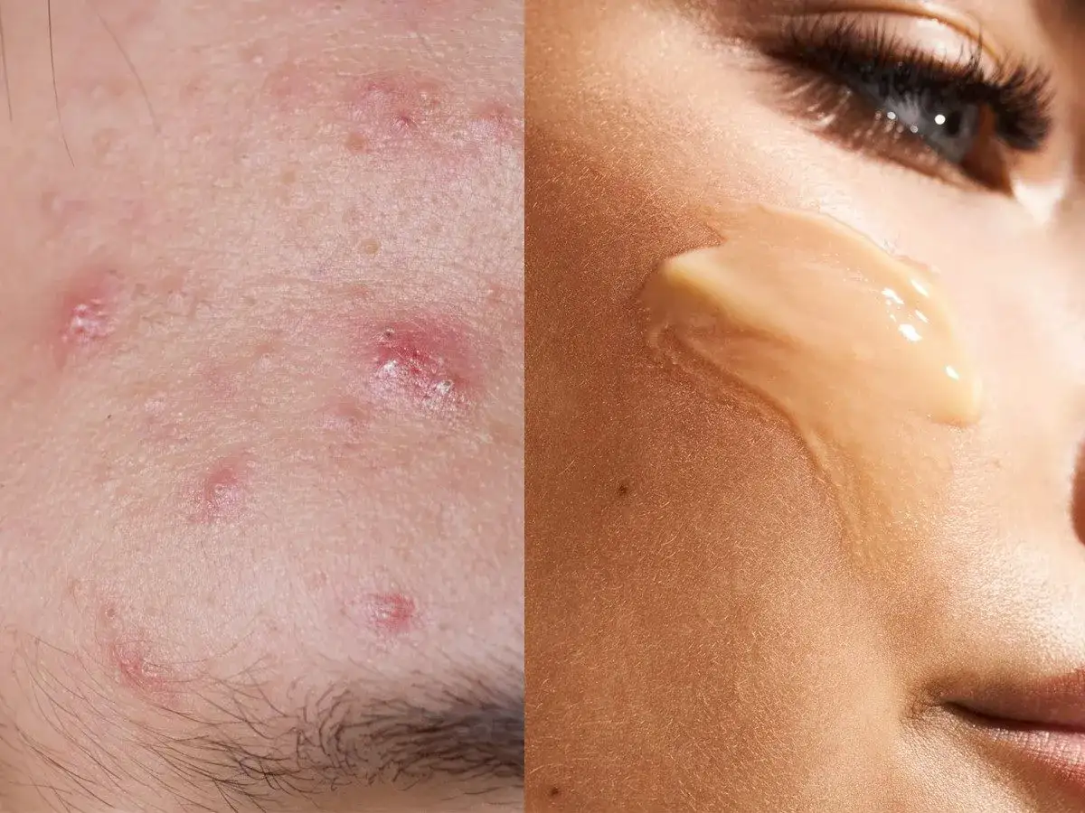 Zdjęcie Ile dni przed okresem wyskakują pryszcze i jak ich uniknąć?