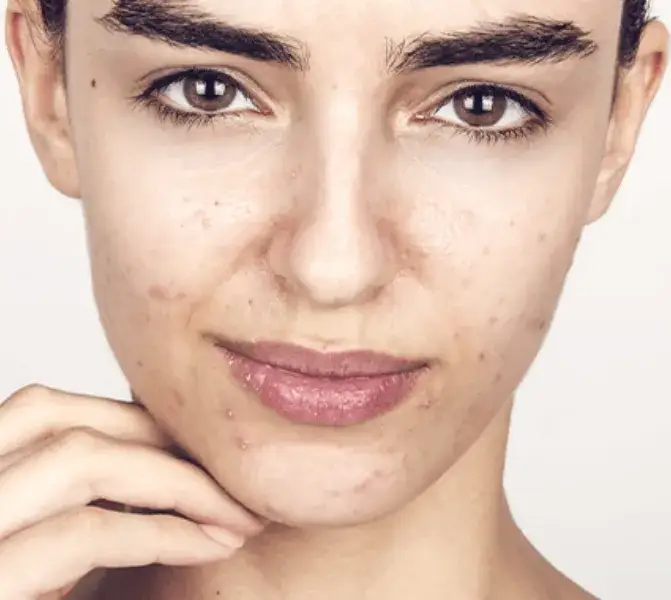 Zdjęcie Jak dbać o cerę trądzikową: skuteczne sposoby na zdrową skórę
