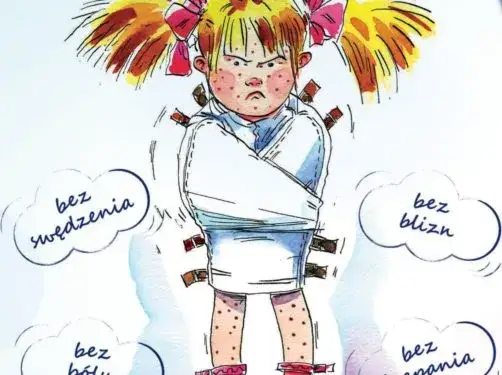 Zdjęcie Ospa w przedszkolu co robić: kluczowe kroki dla rodziców