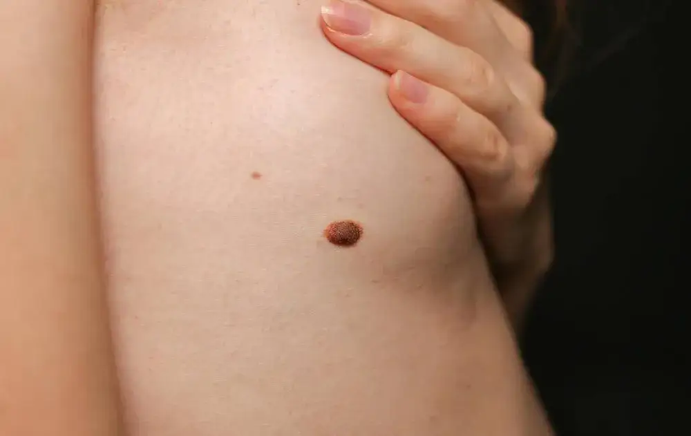 Zdjęcie Pieprzyk boli jak pryszcz – co to oznacza i kiedy iść do lekarza