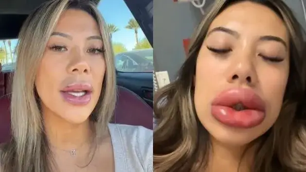 kobieta delikatnie masująca twarz po zabiegu medycyny estetycznej