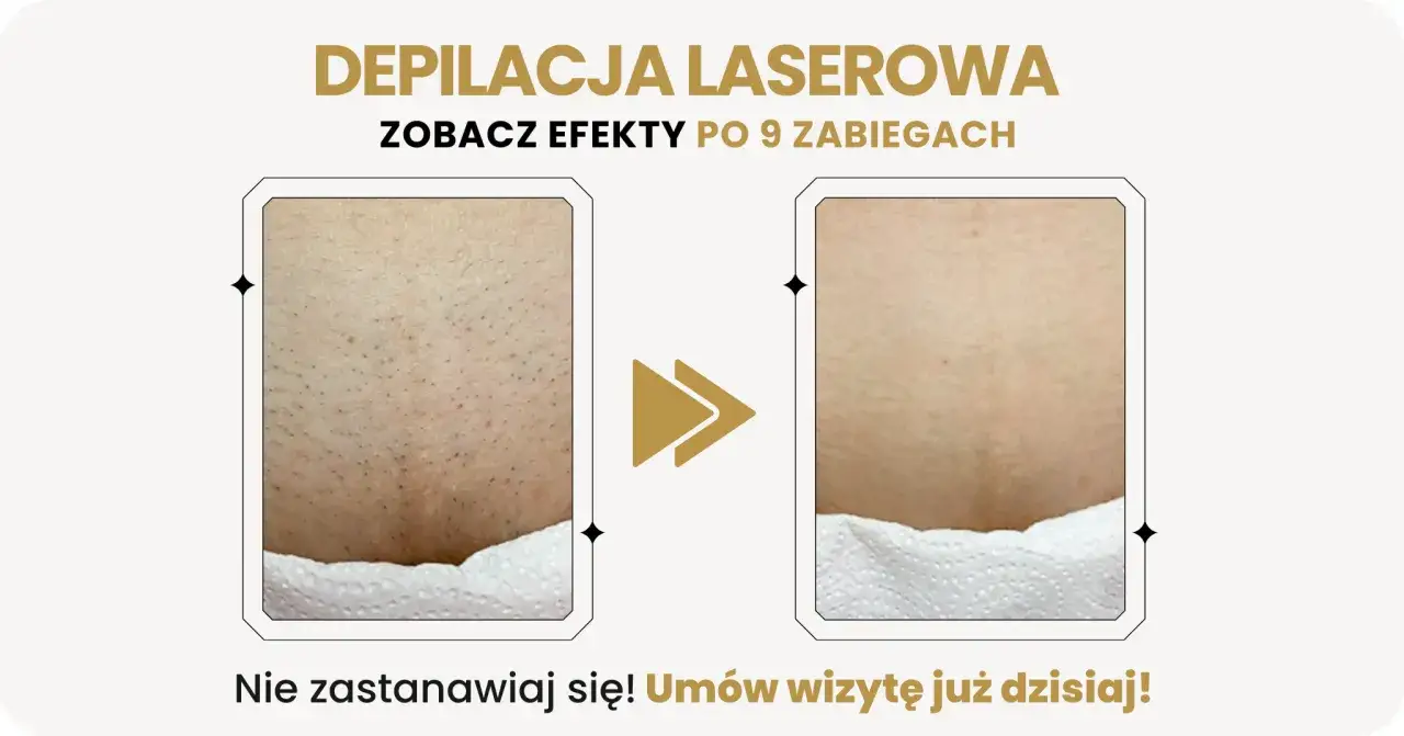 Przed i po laserowym usuwaniu wąsika. Widoczne znaczące zmniejszenie owłosienia po 9 zabiegach.
