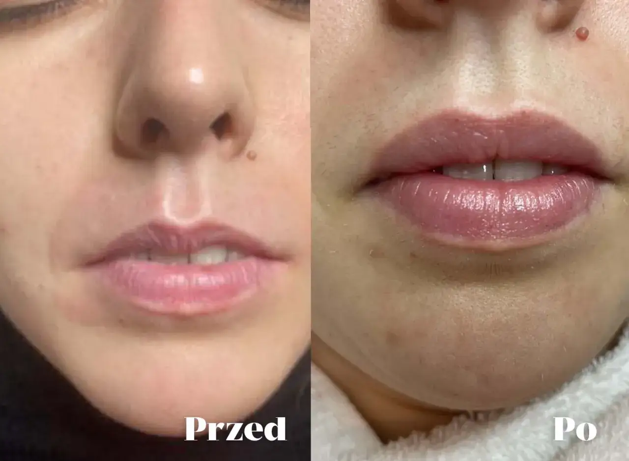 Zdjęcie Kiedy można palić po powiększaniu ust? Ważne informacje i porady