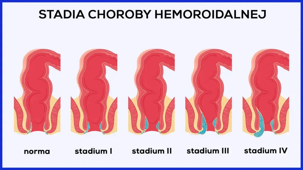Objawy alarmowe chorób odbytu