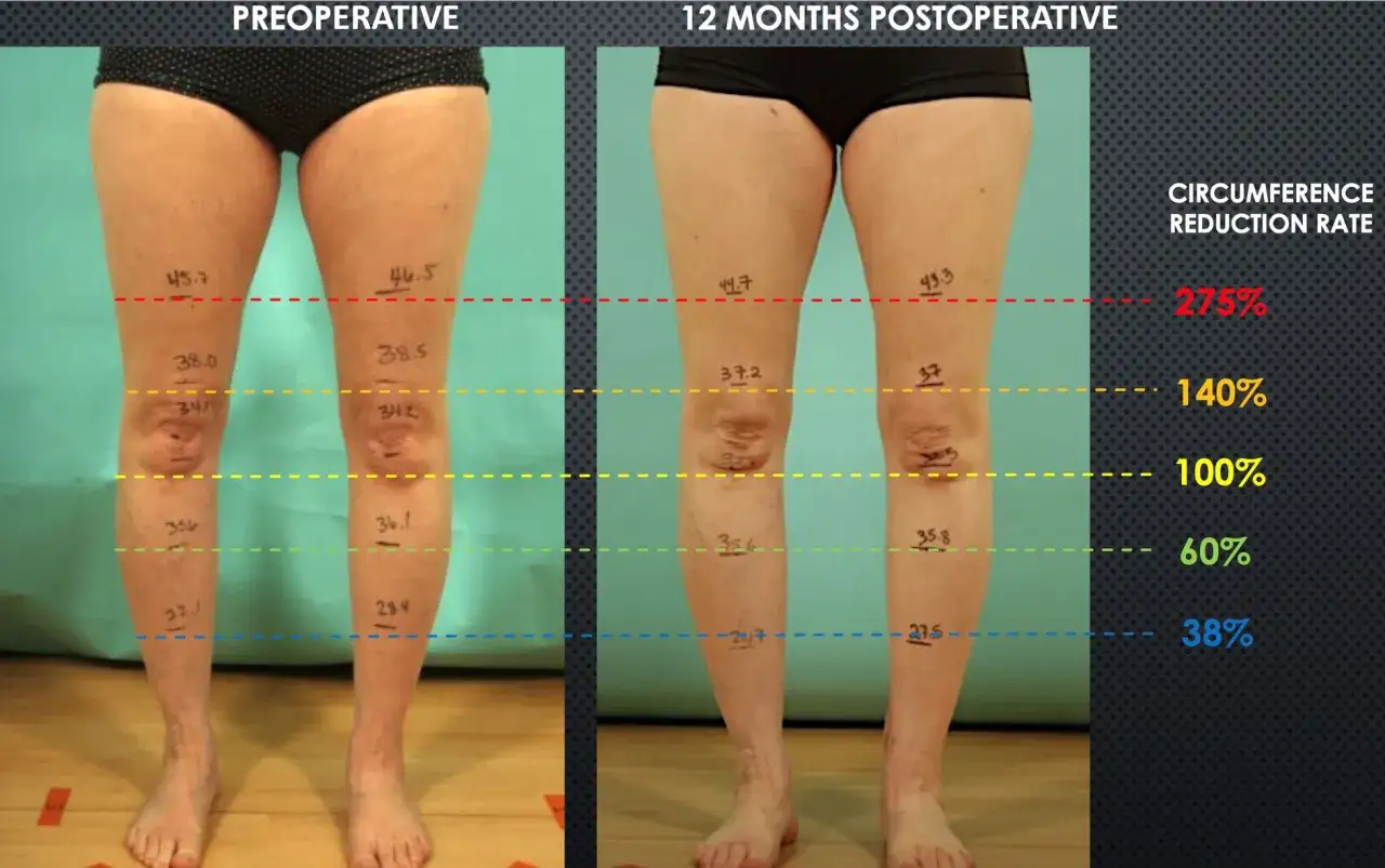 Przed i po operacji: nogi z zaznaczonymi obwodami, pokazujące redukcję obrzęku limfatycznego.