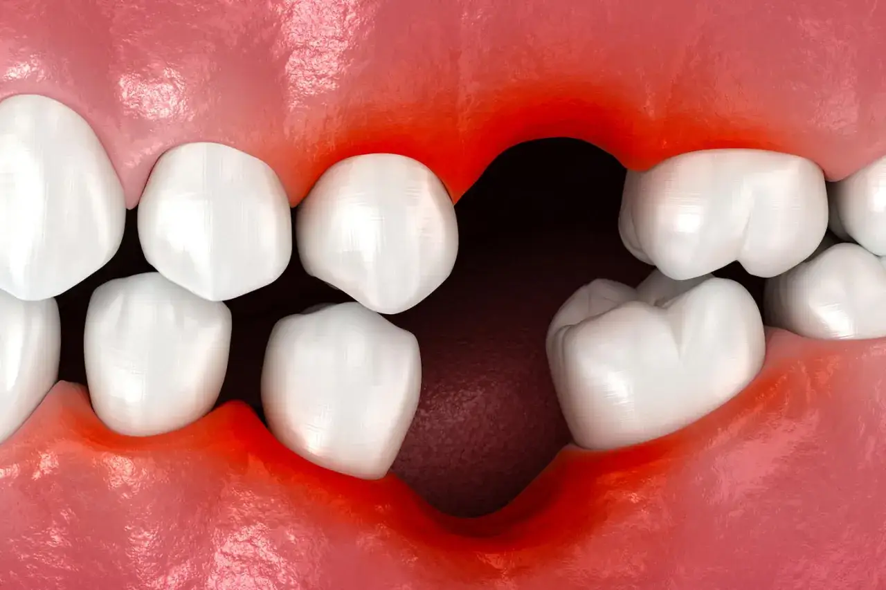 Sączenie krwi po wyrwaniu zęba. Czerwone, opuchnięte dziąsła wokół pustego miejsca po zębie.