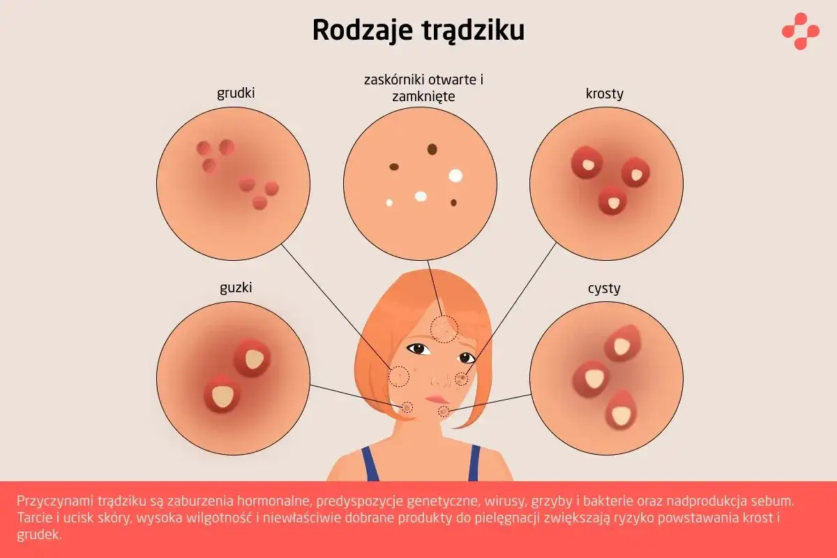 dieta na trądzik produkty zalecane i zakazane