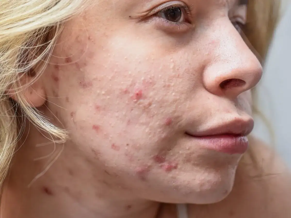 r&oacute;żne preparaty na pryszcze bez recepty, maść cynkowa, plasterki hydrokoloidowe