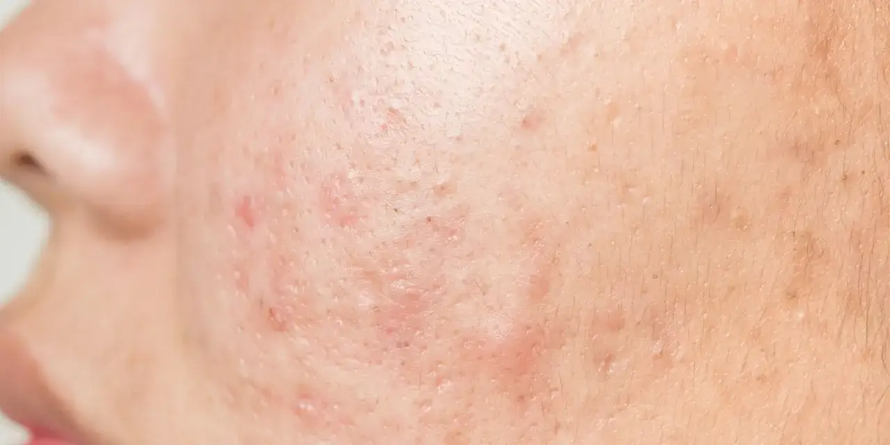 stres a cera trądzikowa