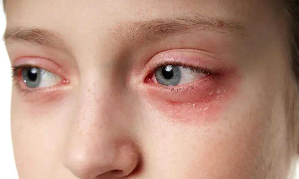 Zdjęcie Alergia oczu: objawy, rozpoznanie i skuteczne sposoby na ulgę