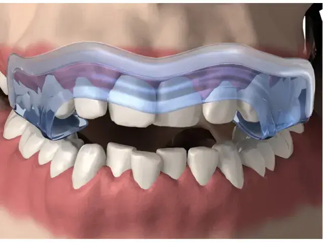 Zdjęcie Szyna zgryzowa Aqualizer - opinie pacjentów po latach stosowania i efekty