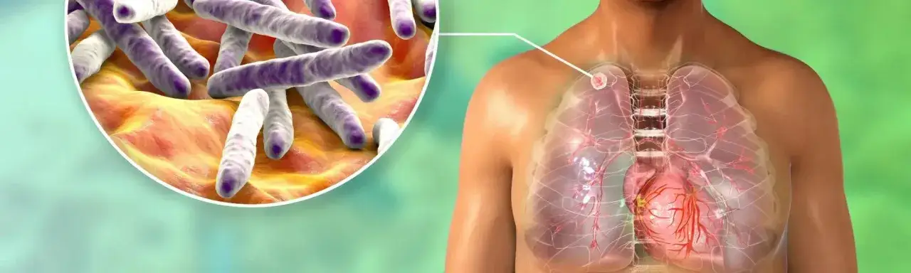 Zdjęcie Jakie są objawy gruźlicy? Poznaj wszystkie sygnały ostrzegawcze choroby