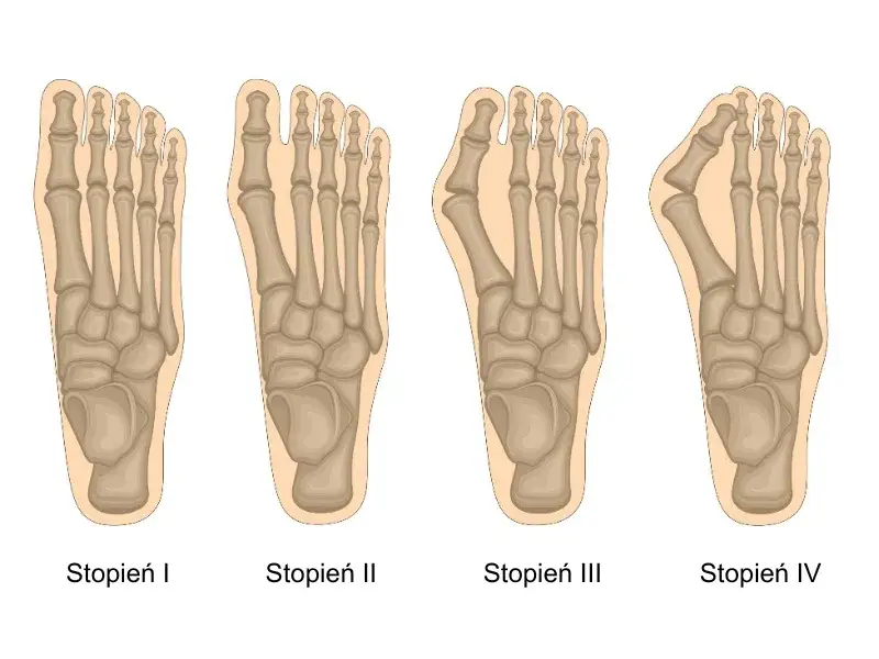 Haluks stopnie zaawansowania deformacji wizualizacja