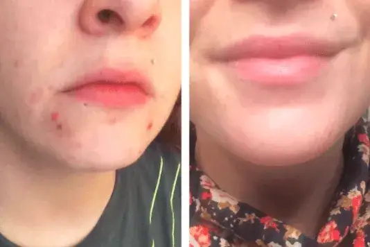 Serum z witaminą C efekty przed i po