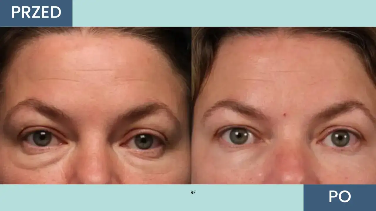 Przed i po zabiegu: wygładzone zmarszczki pod oczami. Dowiedz się, ile kosztuje botoks pod oczy i jak może odmienić Twój wygląd.