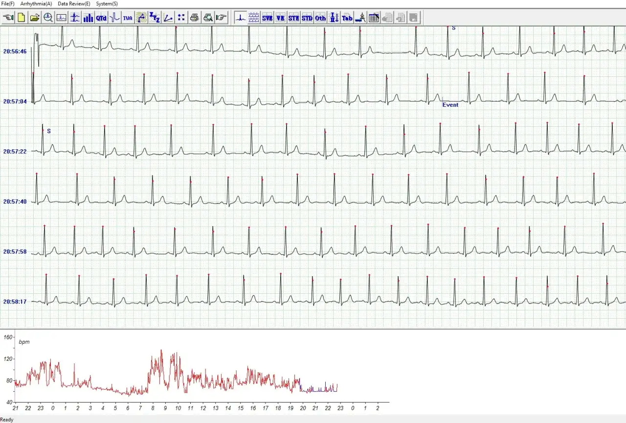 przykładowy zapis ekg