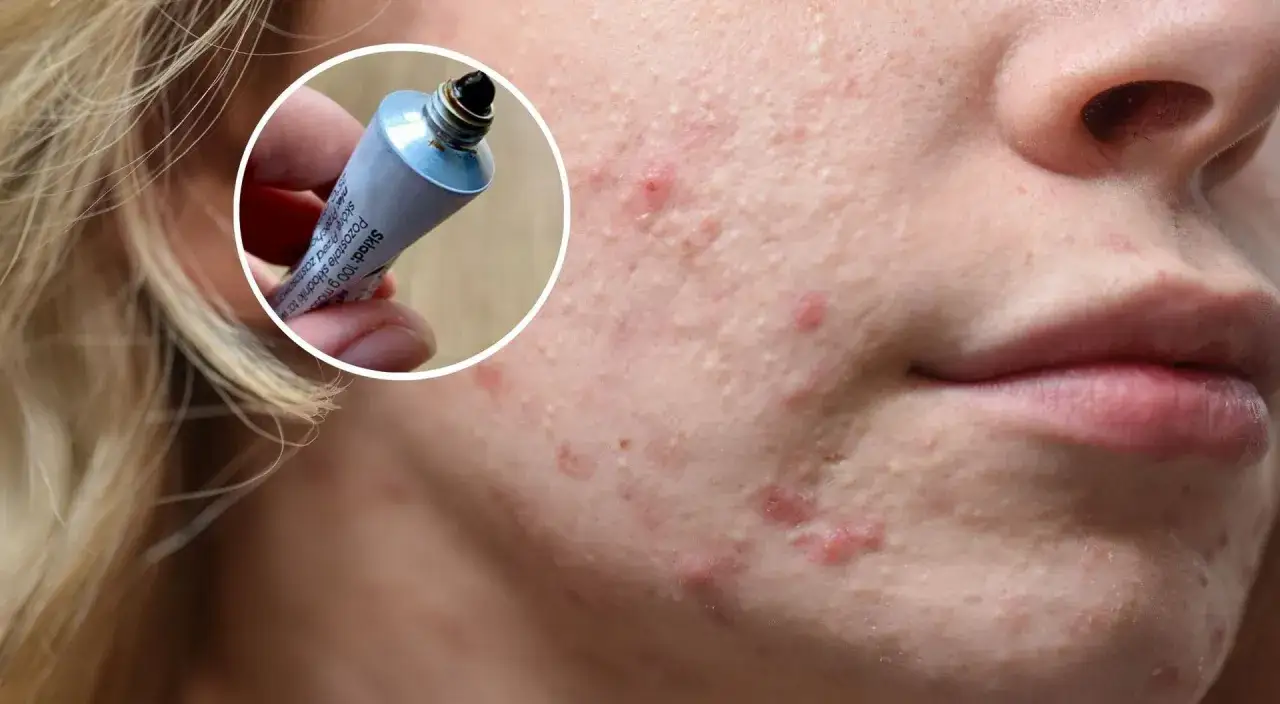 maść ichtiolowa przed i po