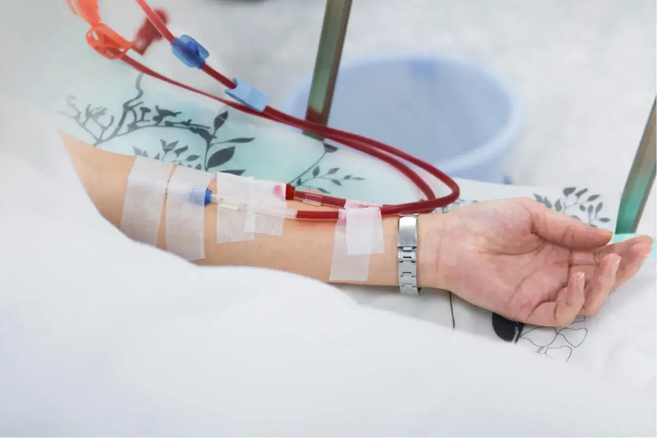 Ramię pacjenta z założonym cewnikiem tunelizowanym do dializy, podłączonymi czerwonymi przewodami.