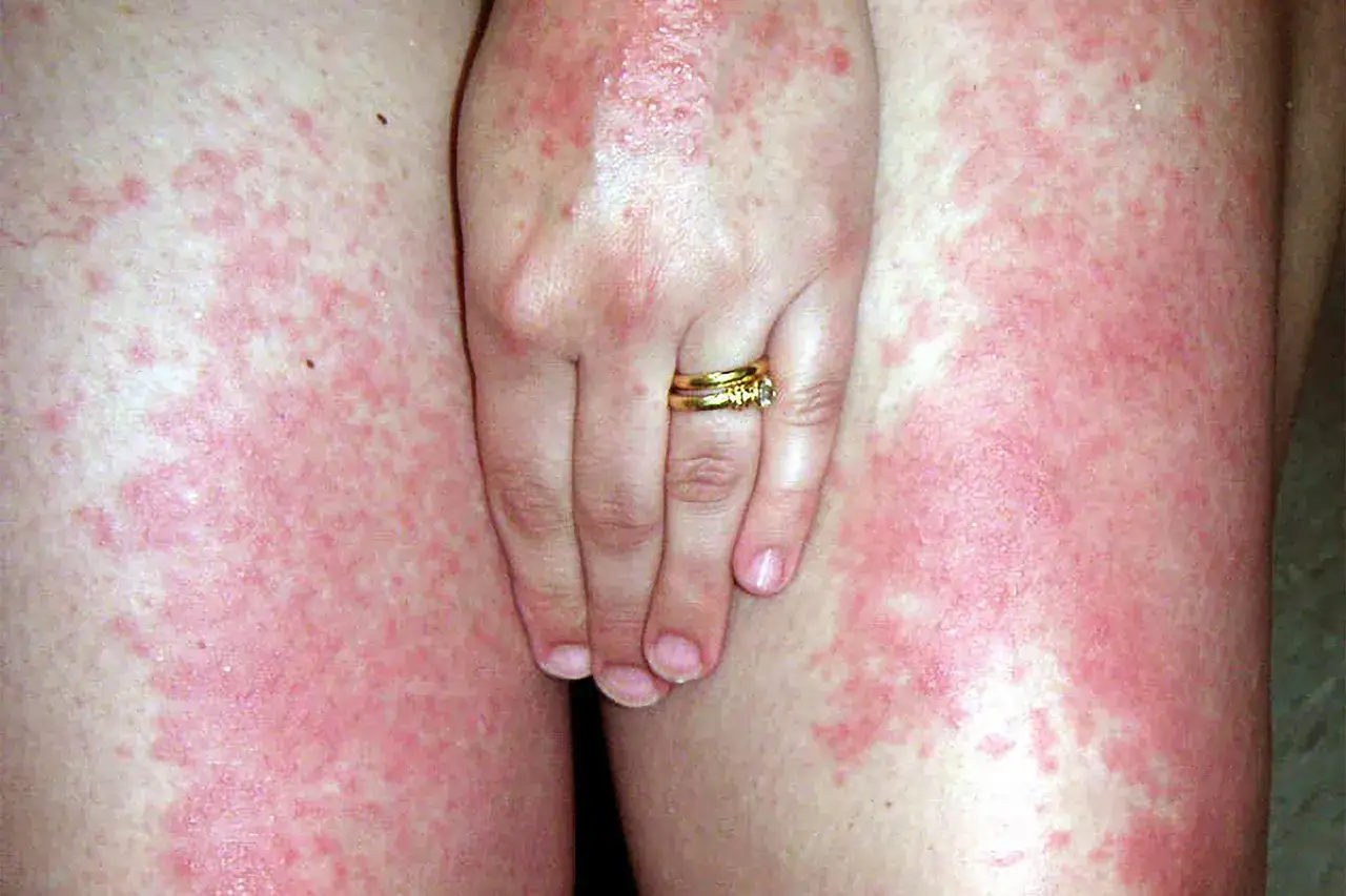 Sk&oacute;ra pokryta zaczerwienieniem i wysypką, prawdopodobnie reakcja na antybiotyk i słońce. Dłoń z obrączką na pierwszym planie.