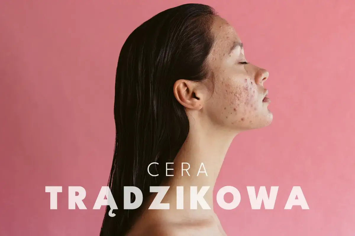 Profil kobiety z cerą trądzikową. Dowiedz się, co zrobić, żeby nie mieć pryszczy i odzyskać gładką skórę.
