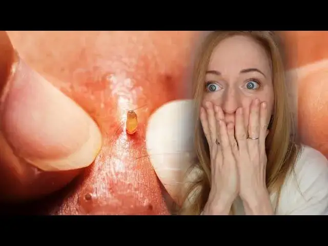 kobieta wyciskająca pryszcz z negatywnymi konsekwencjami