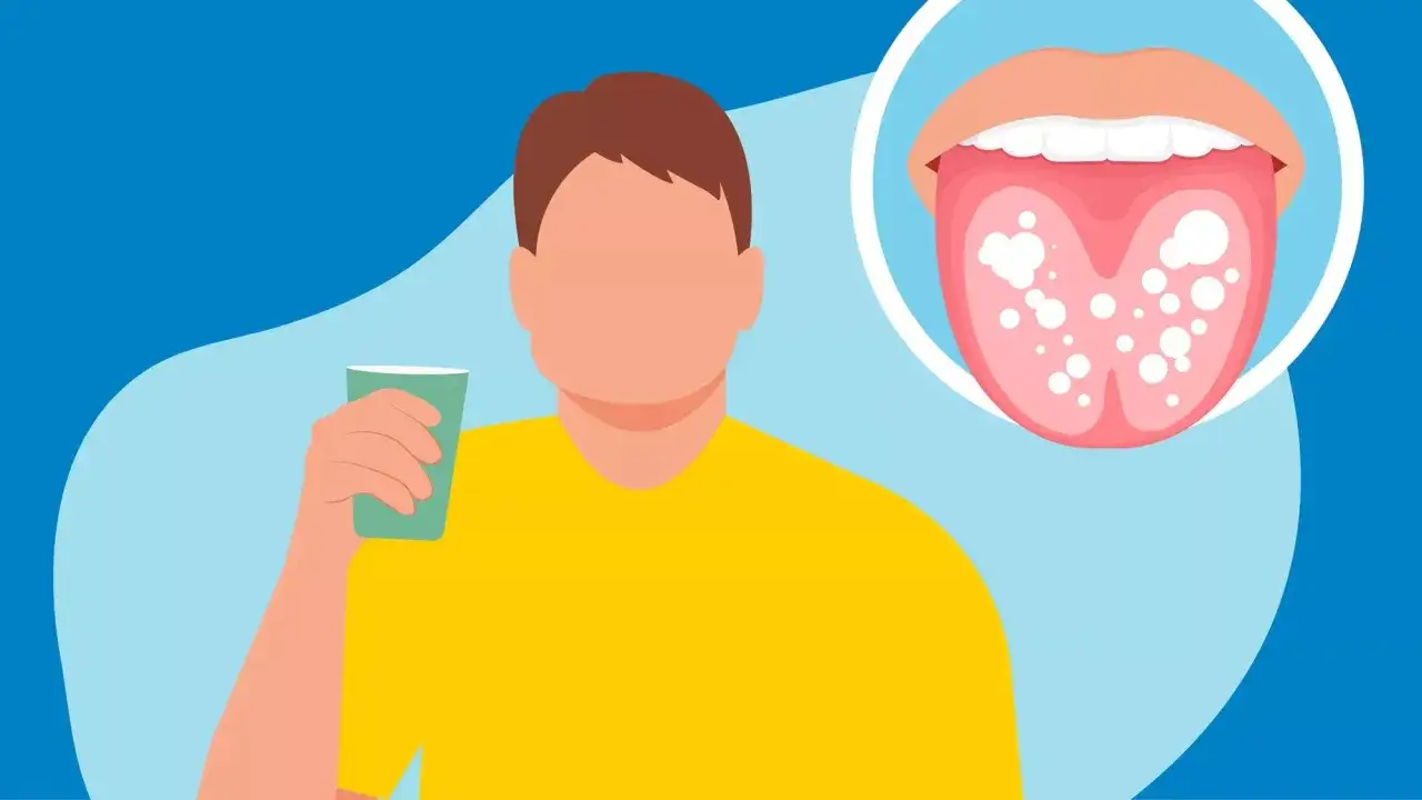 Szukasz domowych sposobów na pleśniawki? Zobacz, jak możesz sobie pomóc, gdy pojawią się białe naloty na języku.