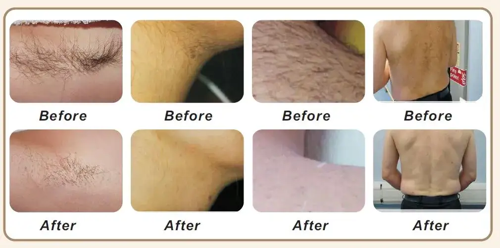 Porównanie bólu depilacji laserowej z woskowaniem